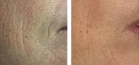 female mouth before and after 2