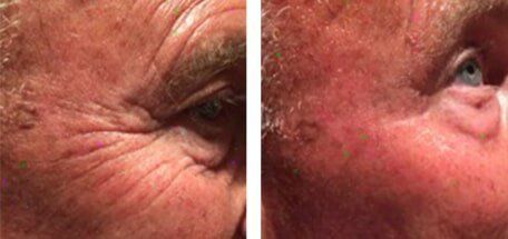 male eyes before and after 1