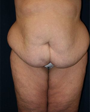 Before tummy tuck photo