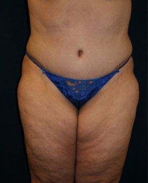 Tummy tuck after photo