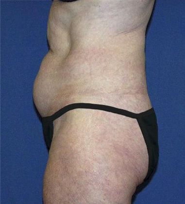 Before Abdominoplasty