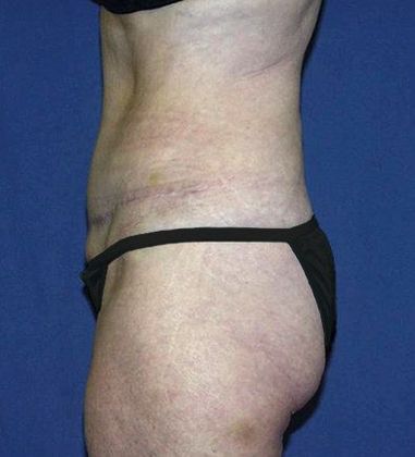 After Abdominoplasty
