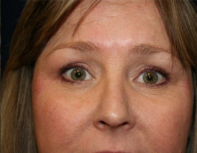 After blepharoplasty