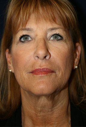 Face lift before photo