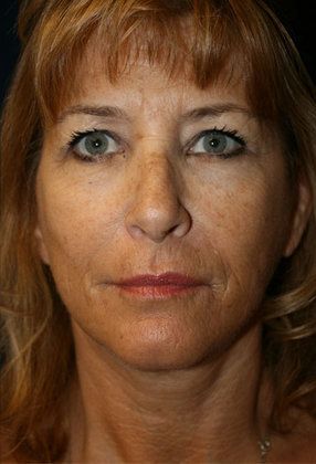 After face lift photo